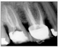 Root Canal Treatment